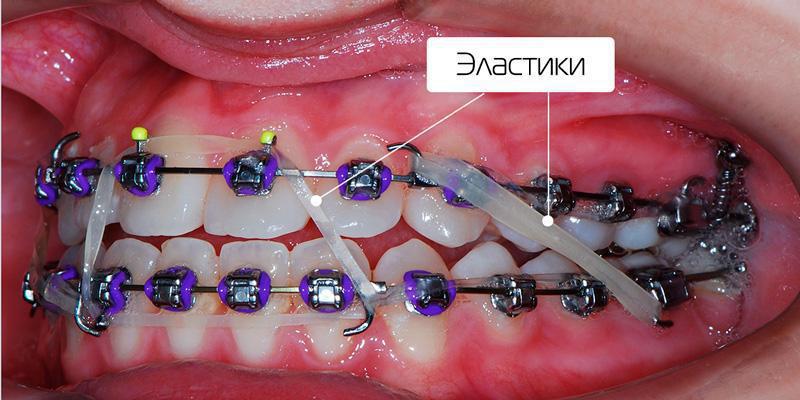 Іригатор - ефективна гігієна ротової порожнини.