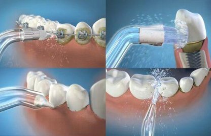 Профілактика карієсу з іригатором