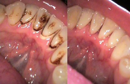 Догляд за зубами з металокераміки