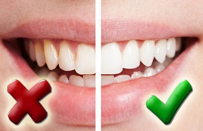 Слиннокам'яна хвороба: що це та чим небезпечна?