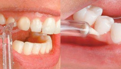 Якісне чищення ротової порожнини з іригатором Pecham